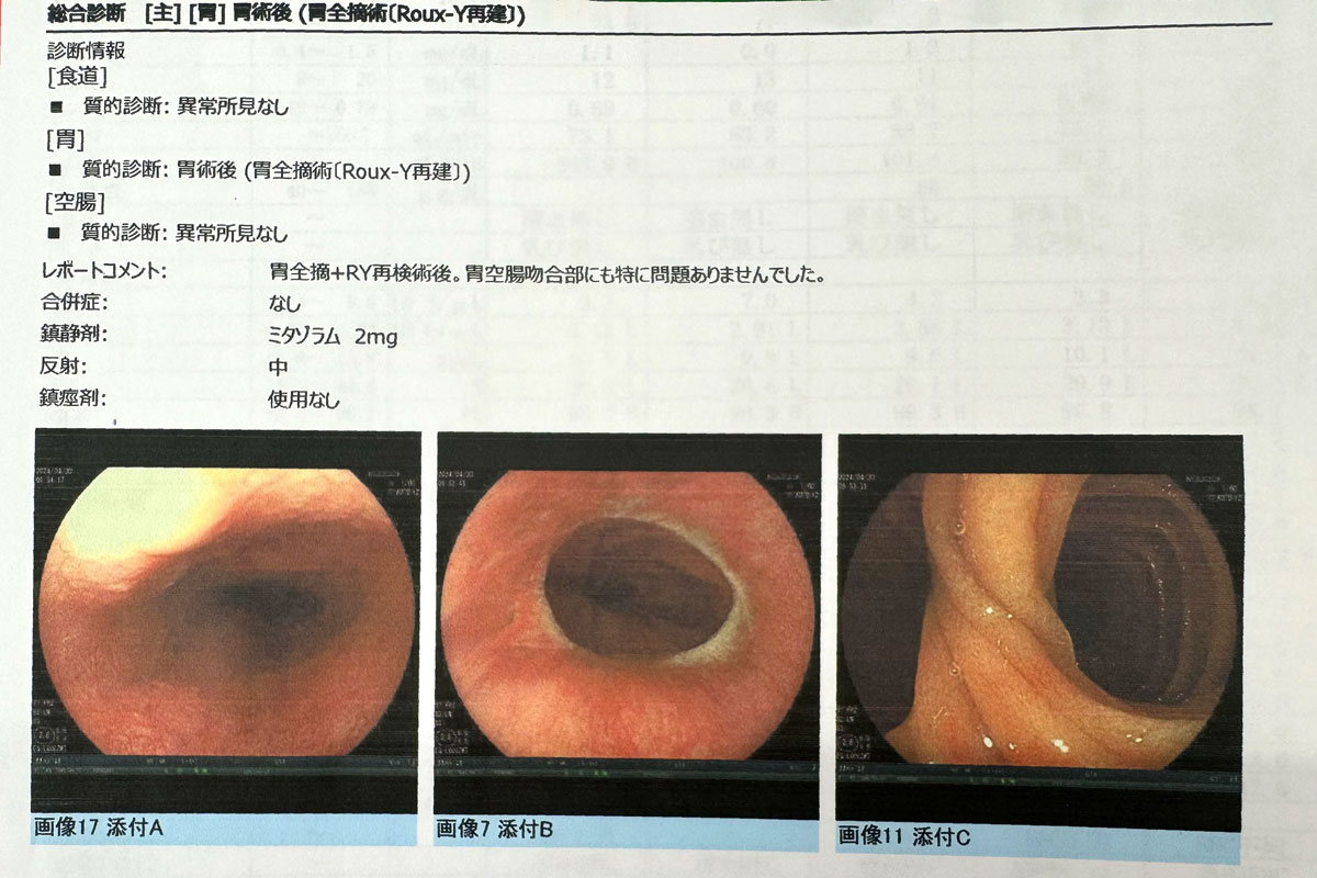 スキルス胃がんの胃全摘手術から1年後の定期検査結果。(再発・転移の経過観察) - 毎日ノンアル.net